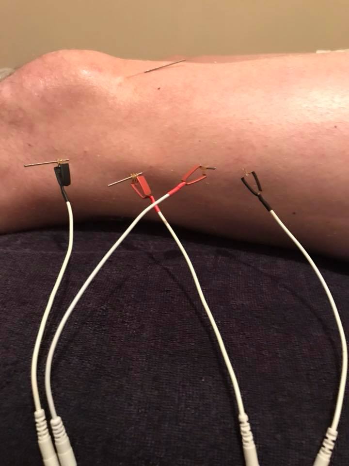 Electrical dry needling